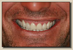 Sedona cosmetic dentistry and teeth whitening - After