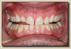 Sedona cosmetic dentistry and teeth whitening - Before